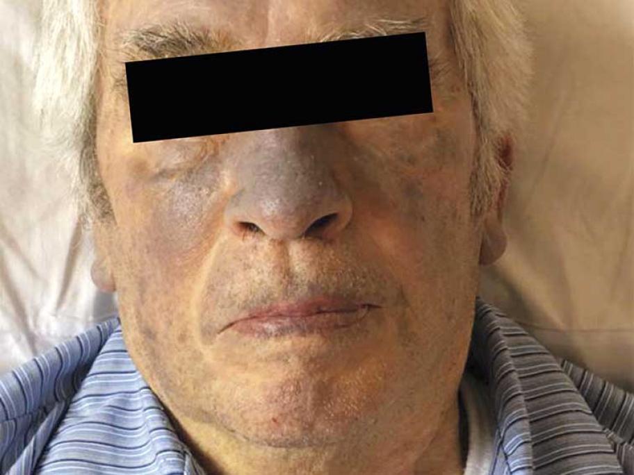 Skin discolouration
