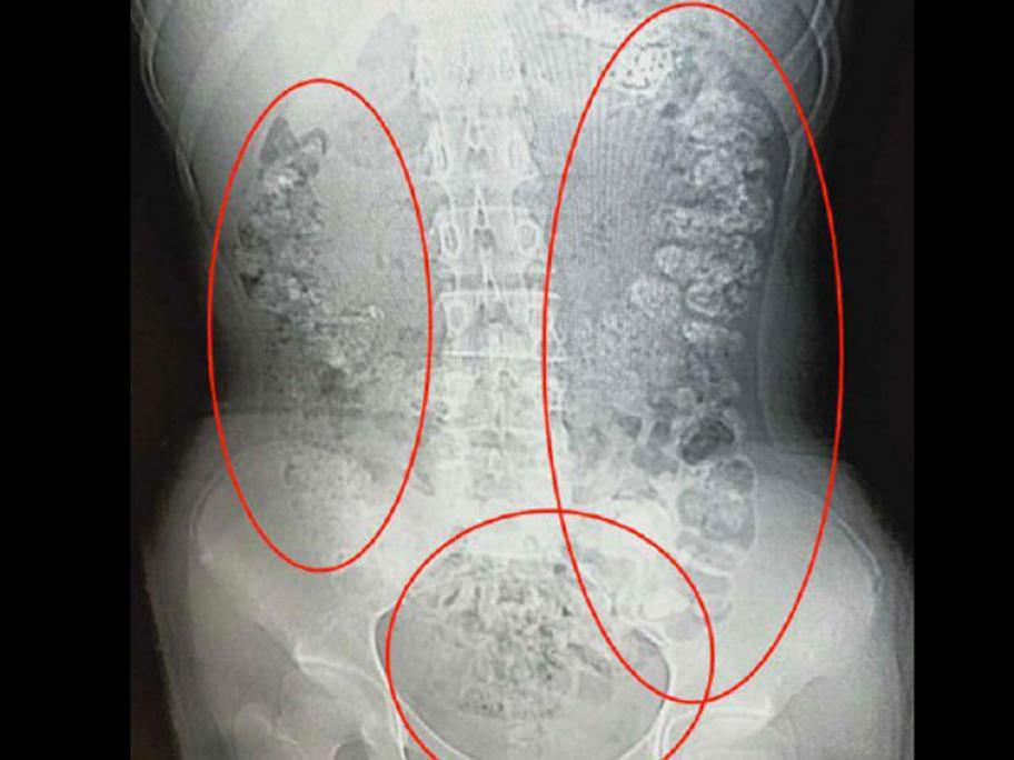 Abdominal CT