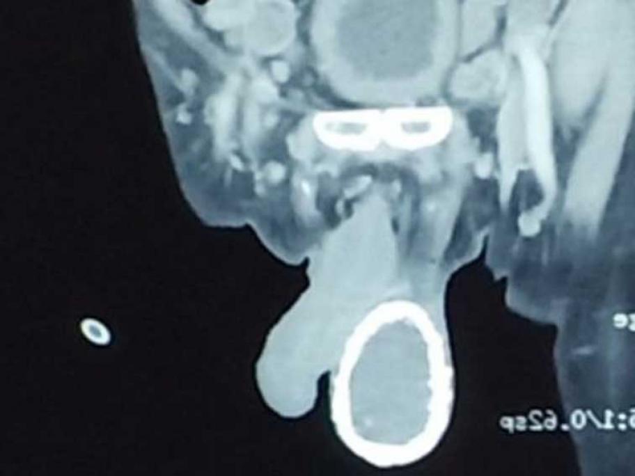 CT scan