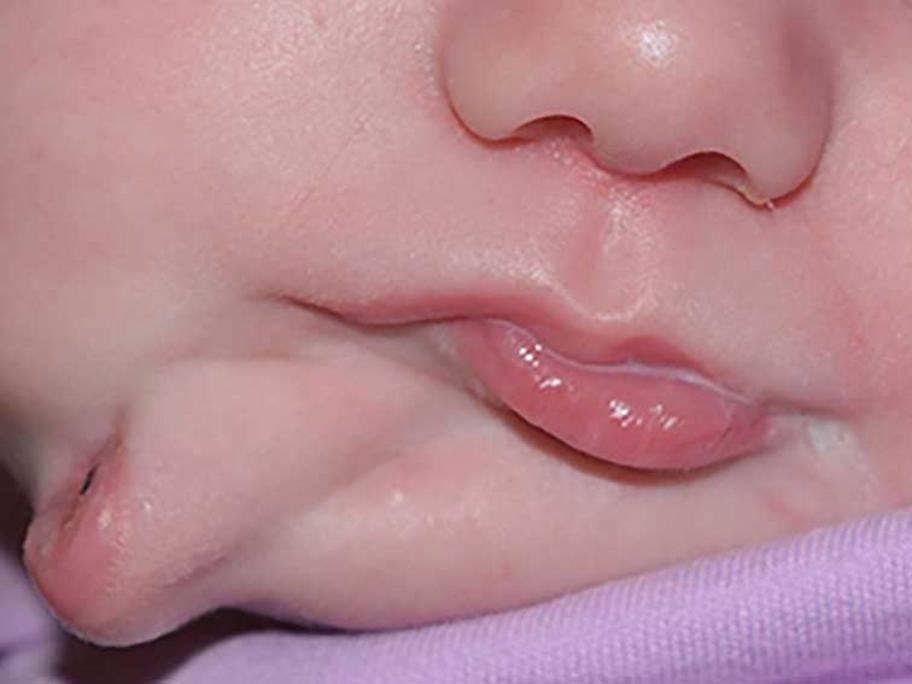 Baby with two mouths