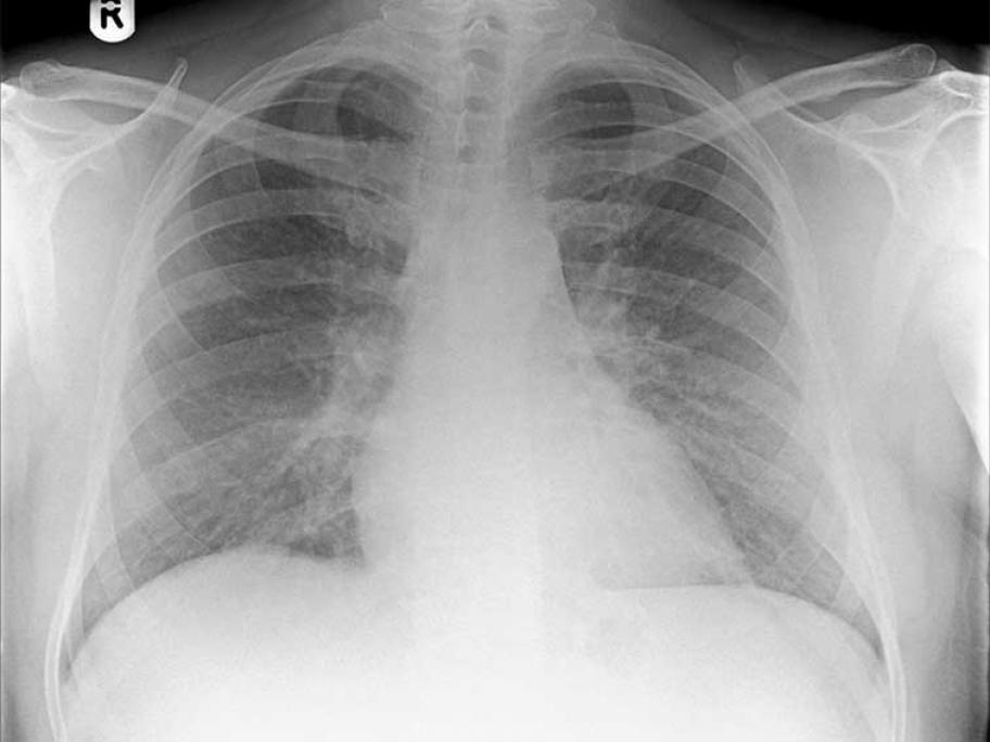 Chest X-ray