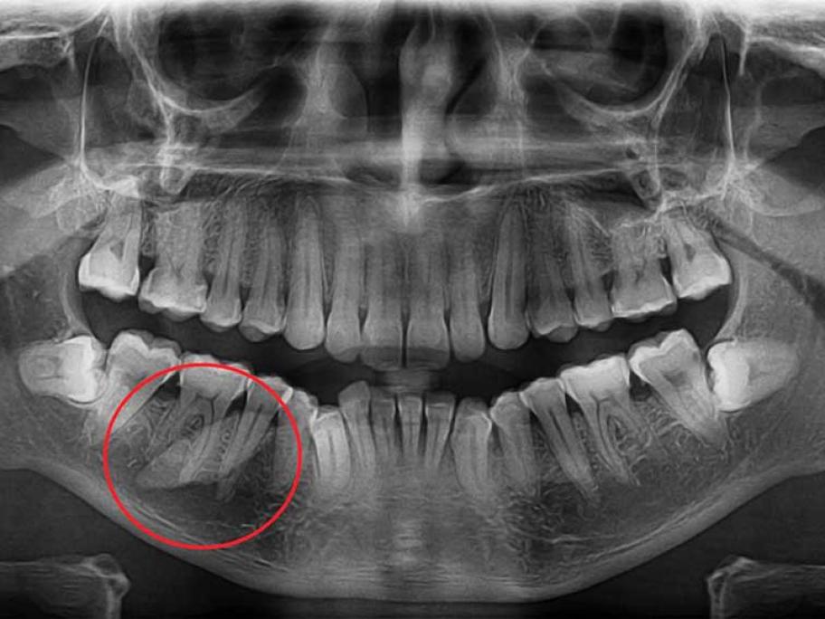 X-ray
