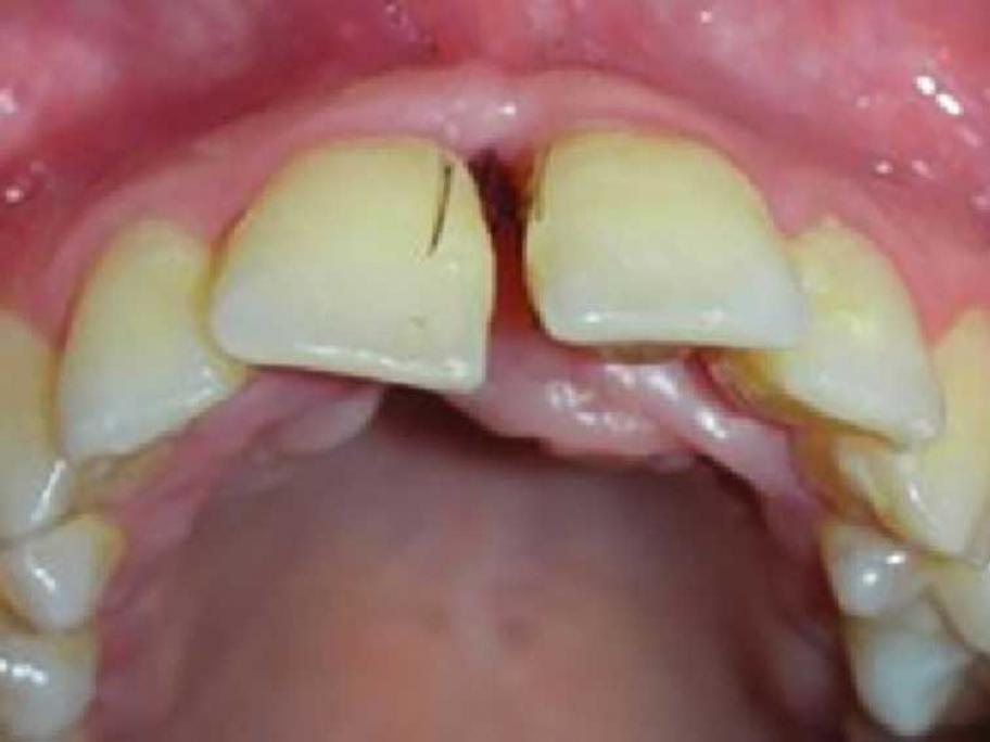 Hair in gums