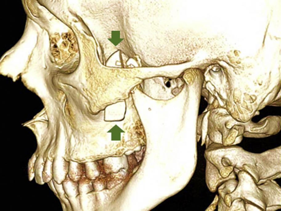 CT scan