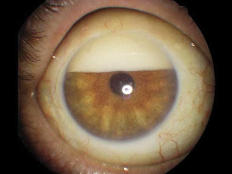 Eye
