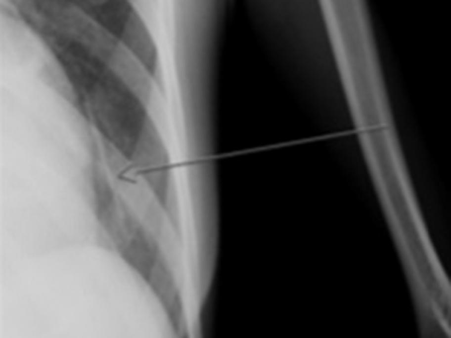 X-ray