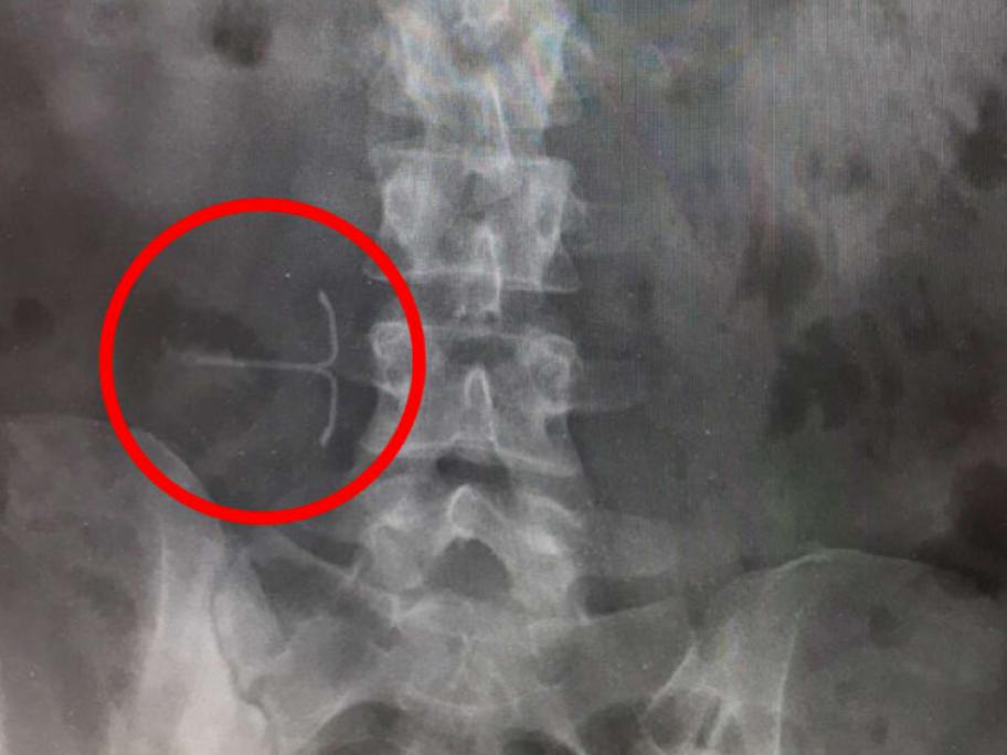 IUD scan