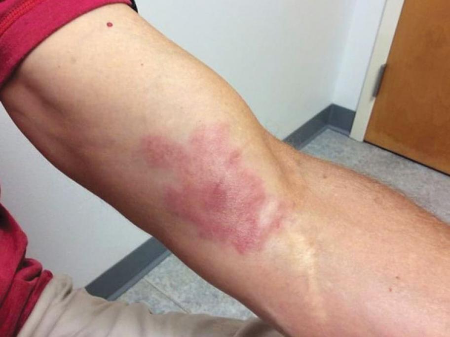 Arm lesion