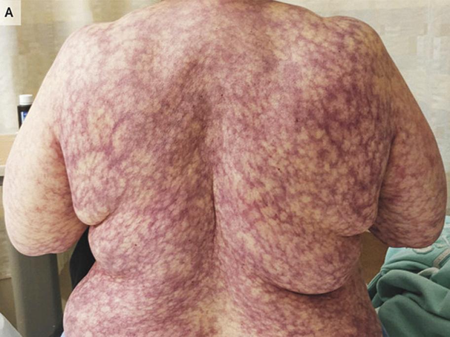 Purple rash