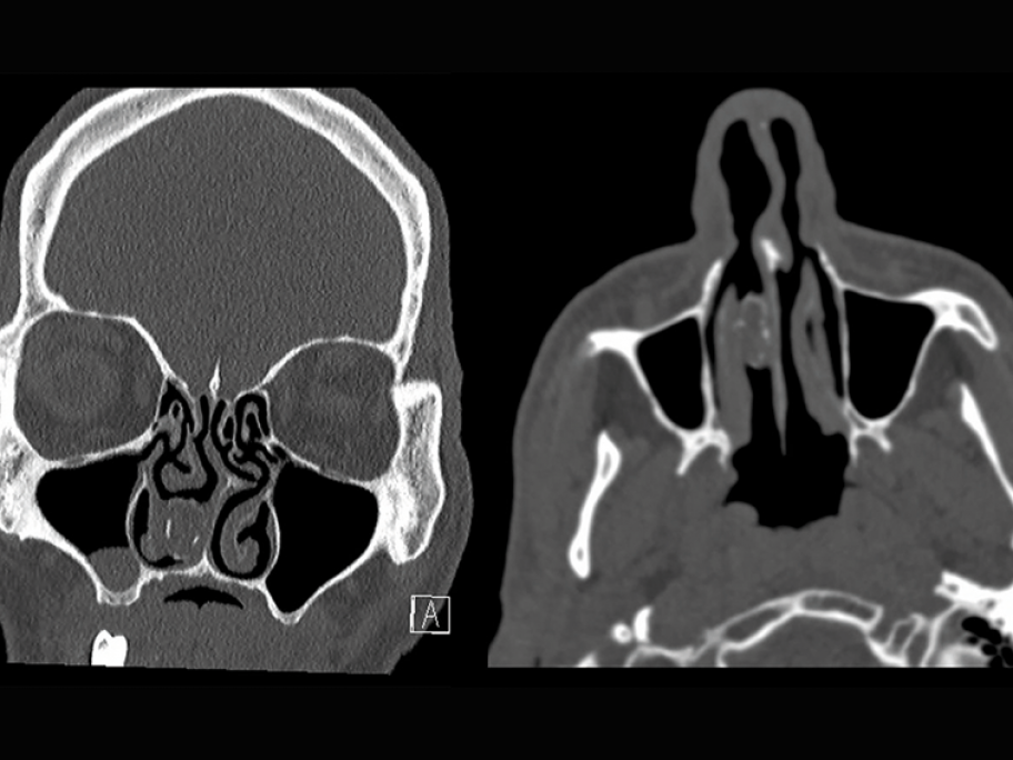 CT scan