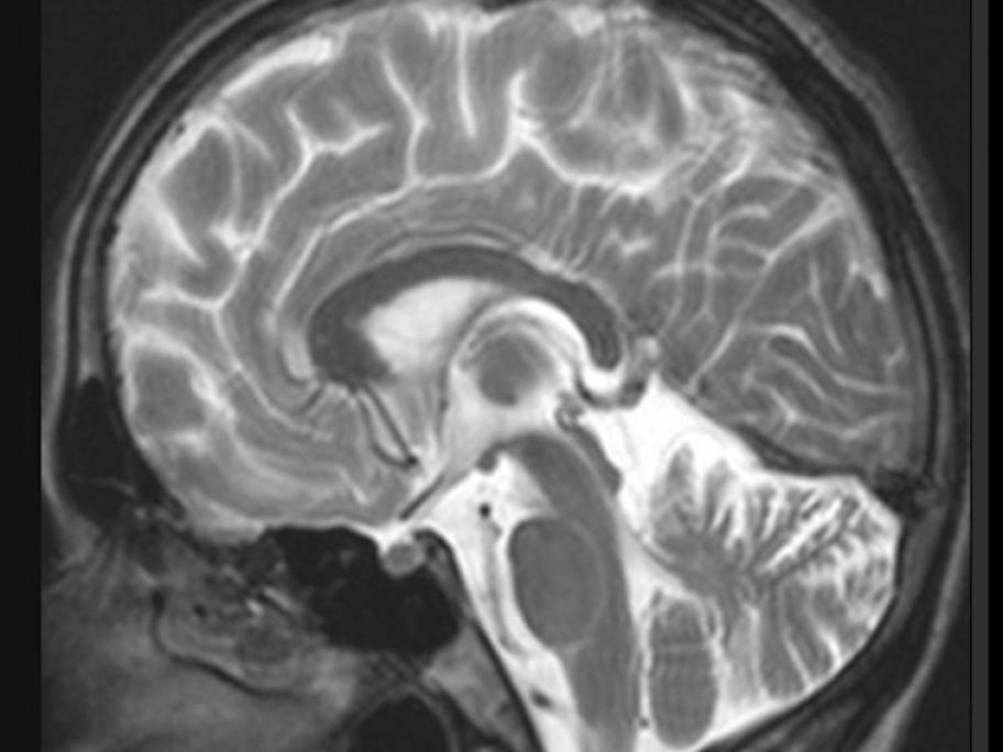 Brain MRI