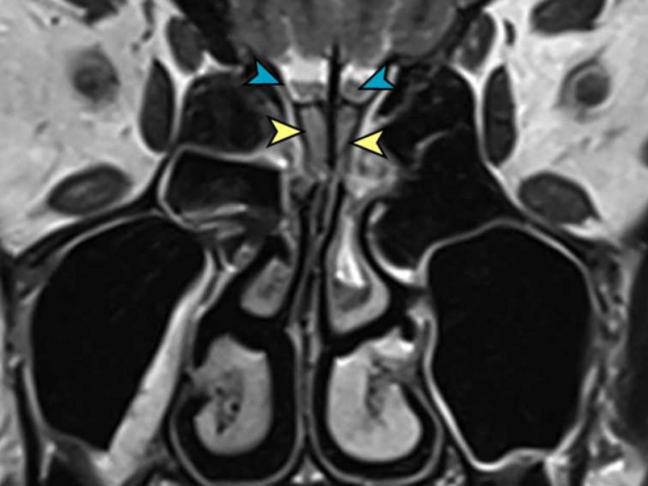 MRI