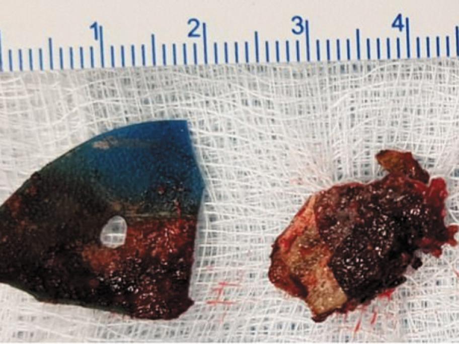 rhinolith