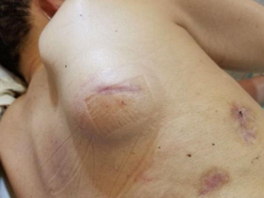 Subcutaneous emphysema