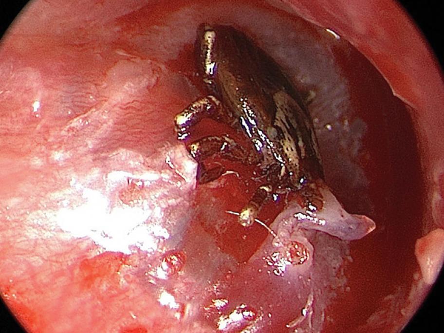 Tick in ear