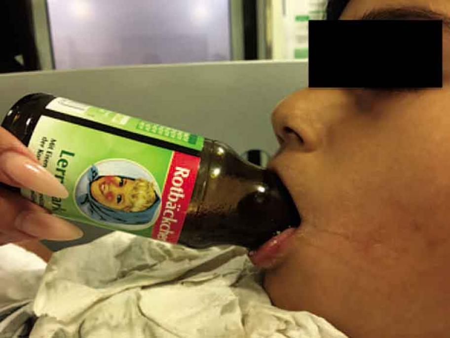 Pic of child with trapped tongue