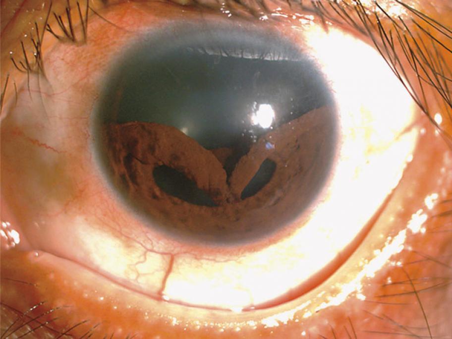 Collapsed iris
