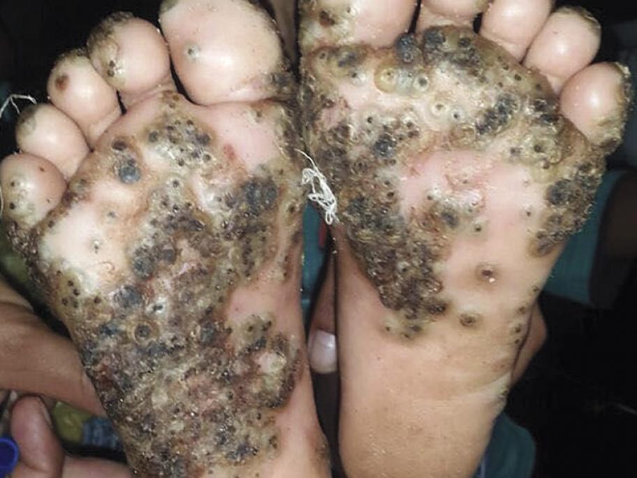 Tungiasis