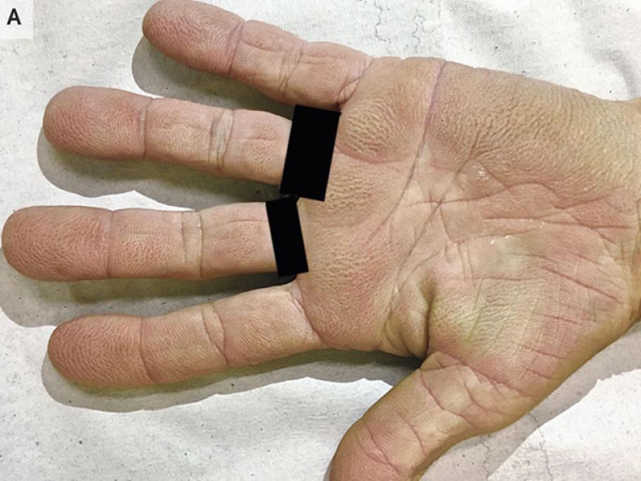 Patient's palms