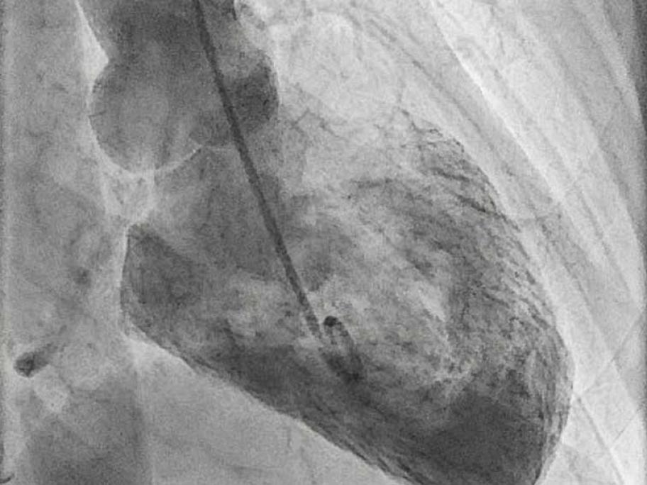Left ventriculography on catheterisation