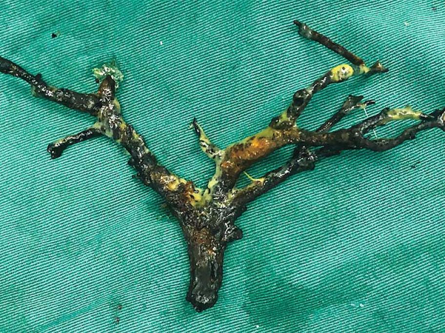 Biliary cast