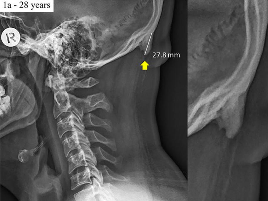 Skull X-ray