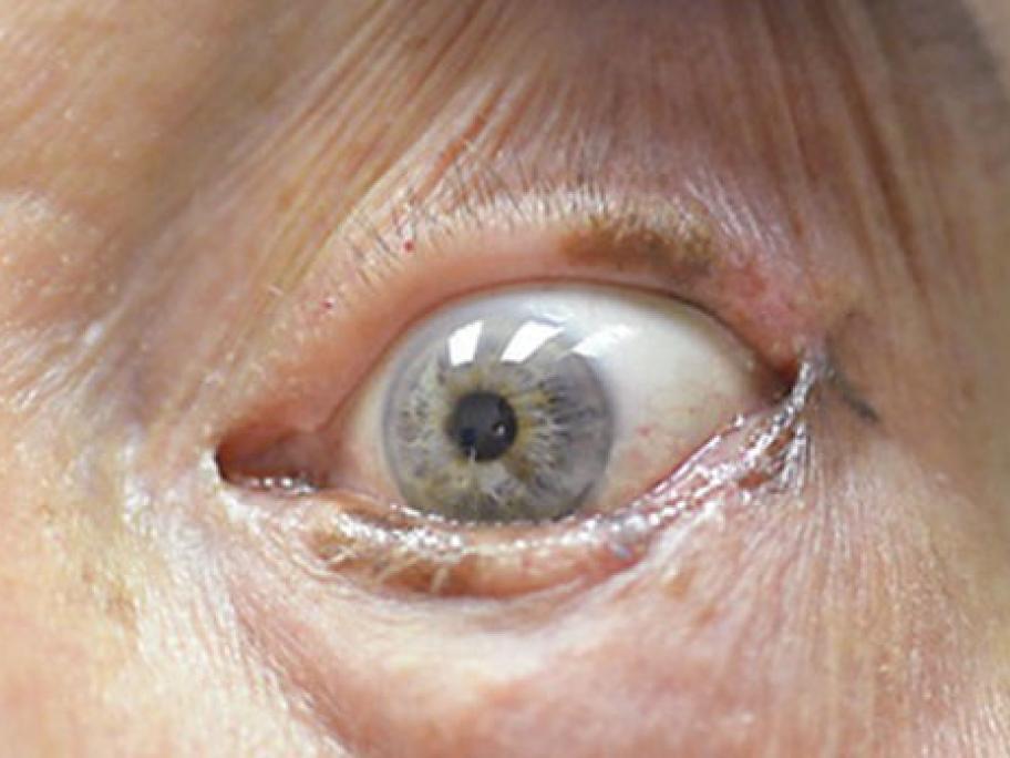 Eye