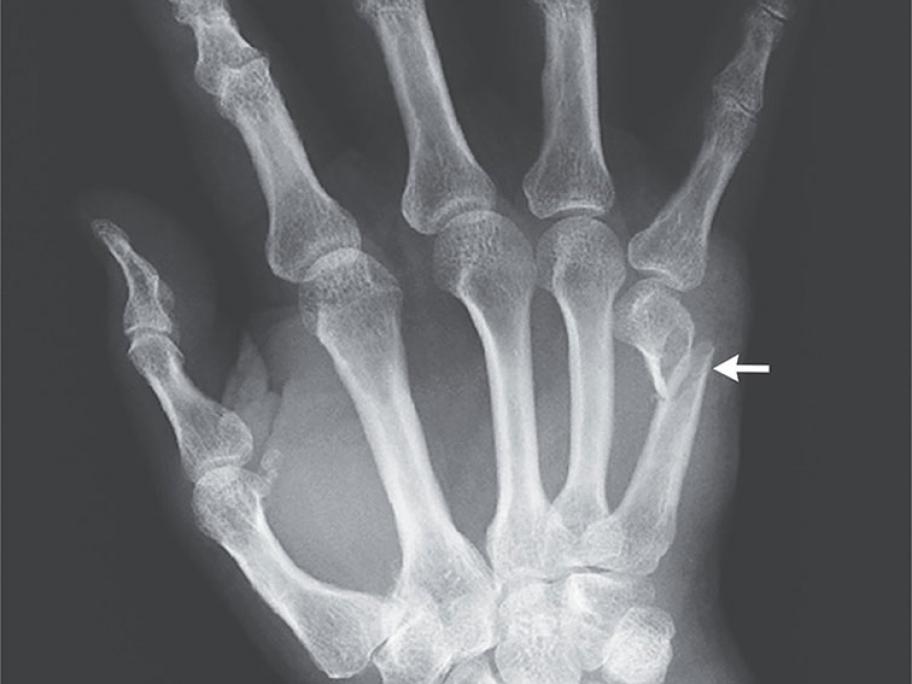 X-ray of hand