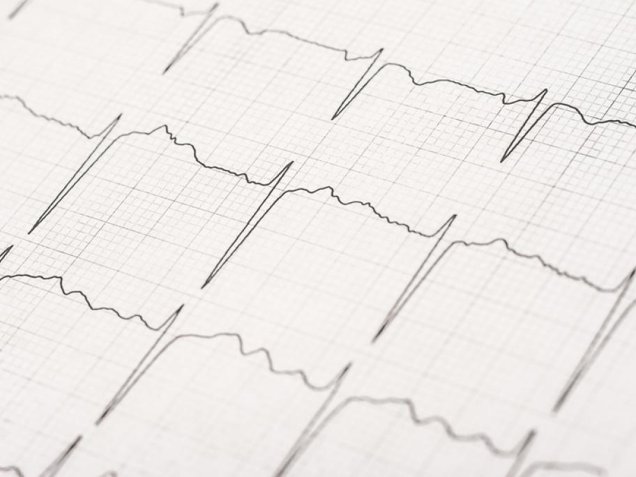 ECG trace