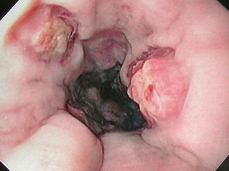 Oesophageal varices post banding