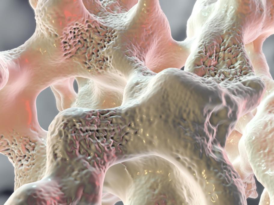 Osteoporosis
