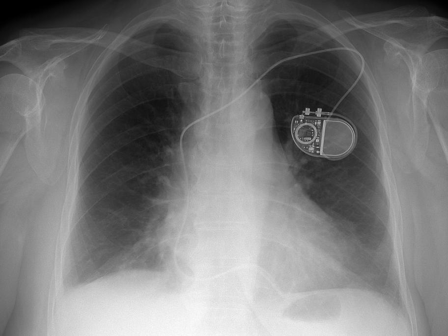 Chest X-ray showing pacemaker