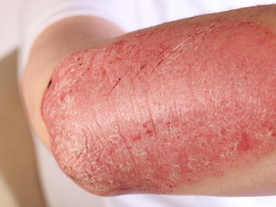 Plaque psoriasis on an arm