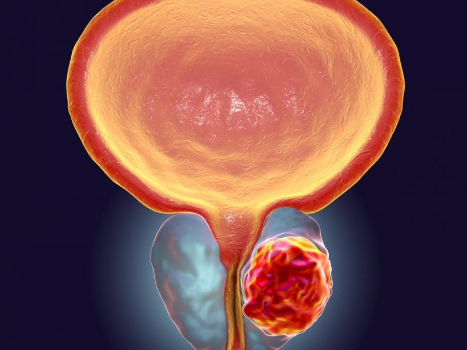 Model illustrating prostate cancer