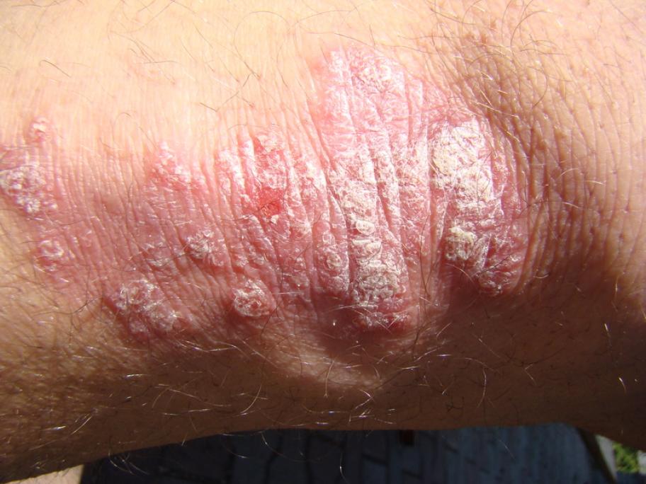 Psoriasis