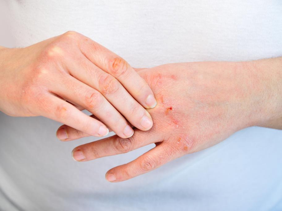 Dermatitis
