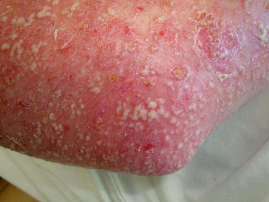 pustular psoriasis