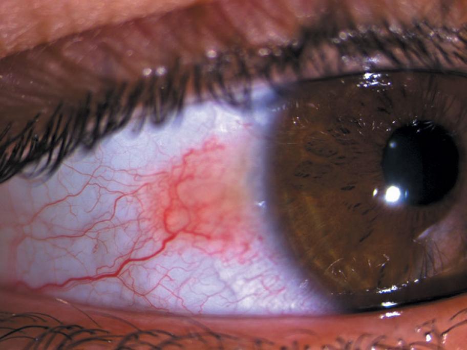 Amelanotic conjunctival naevus