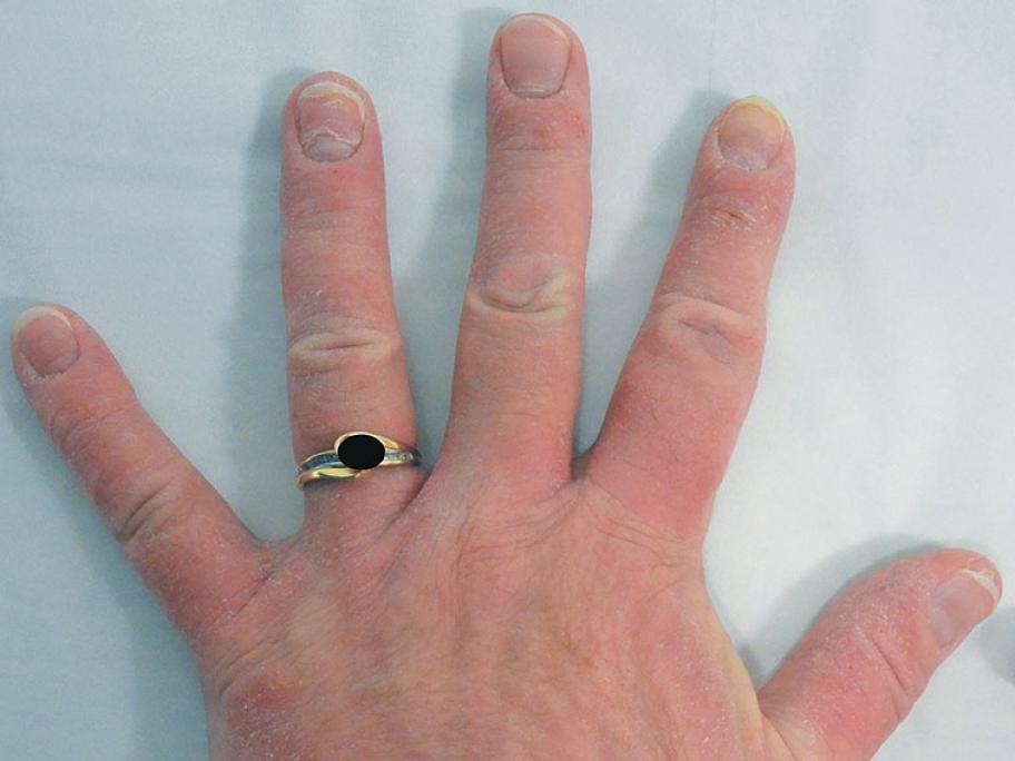 Dermatitis rings
