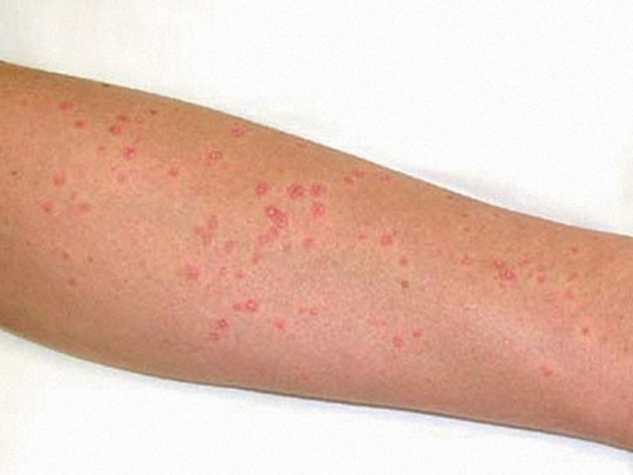 Guttate psoriasis