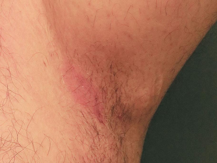 Inverse psoriasis