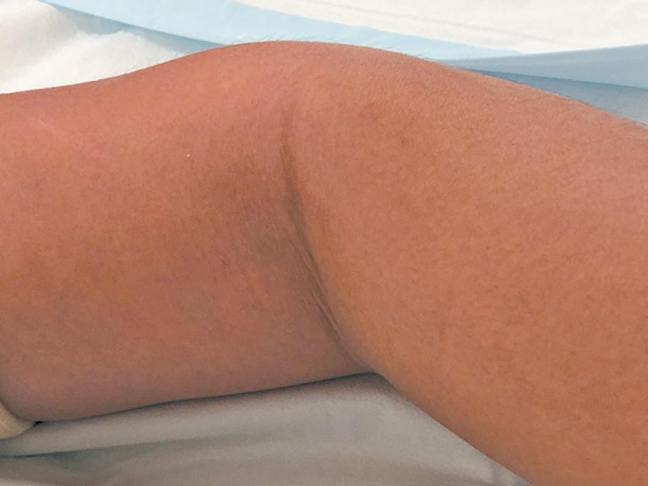 lymphangioma