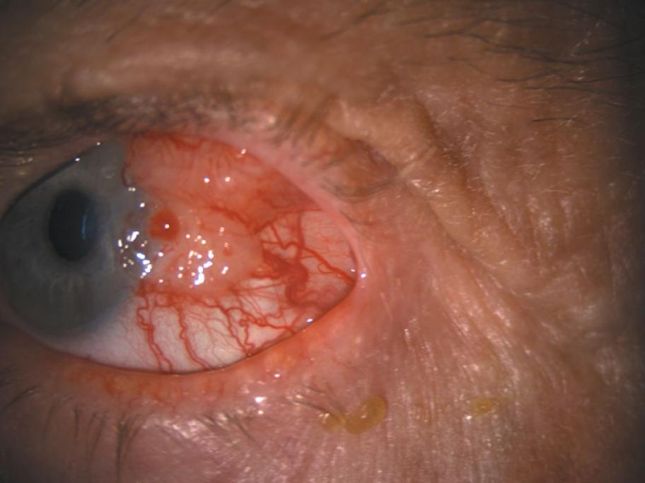 ocular surface squamous neoplasia ossn