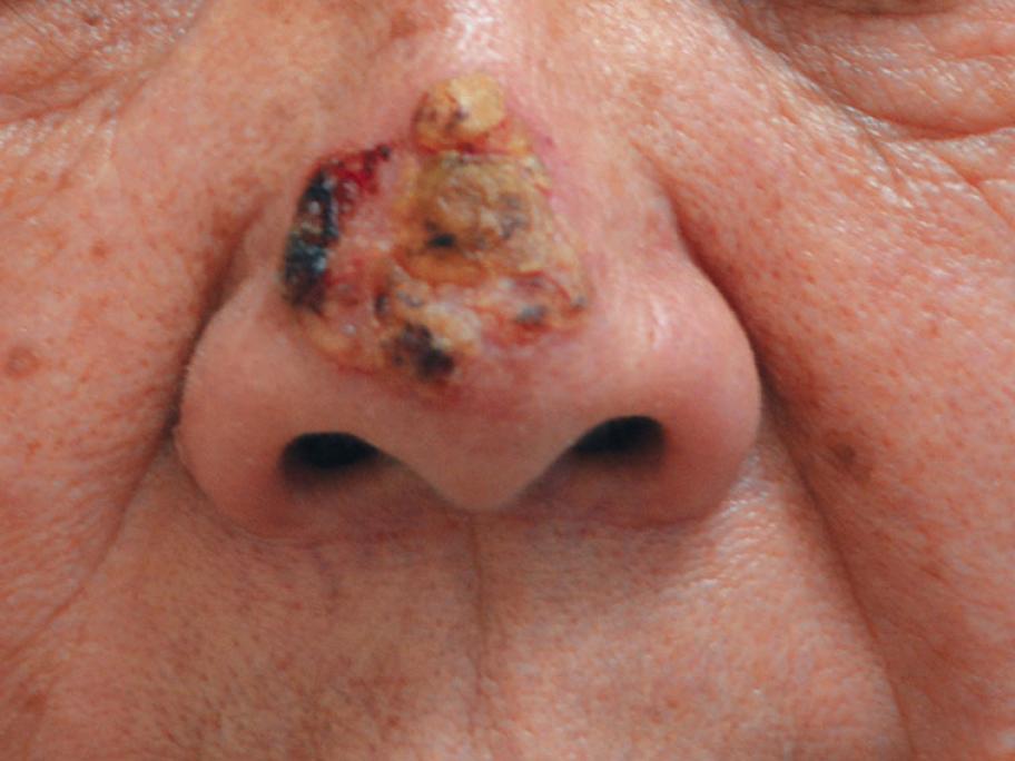 pemphigus vulgaris