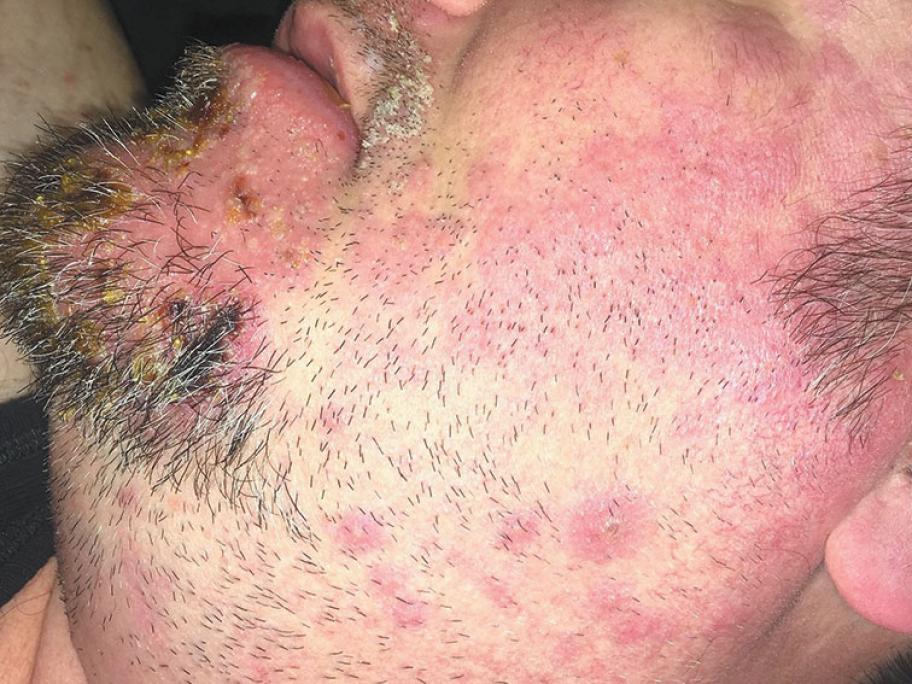 Ramsay hunt syndrome