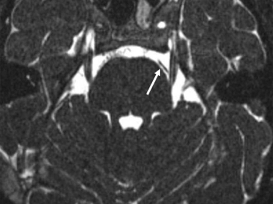 MRI fiesta sequence