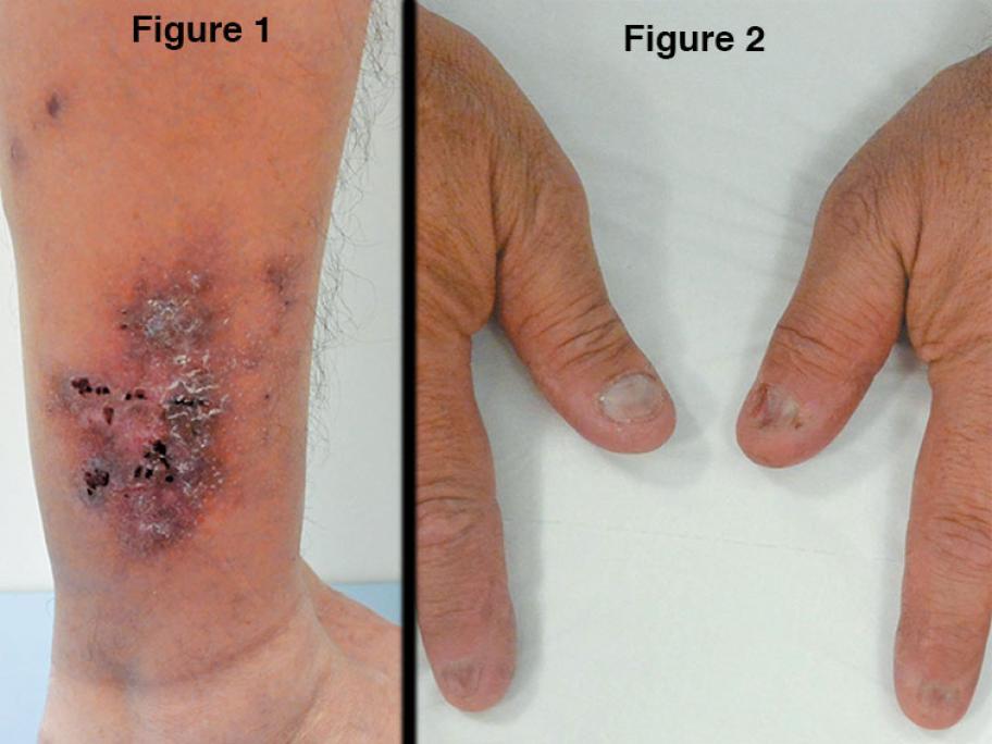 erythematous