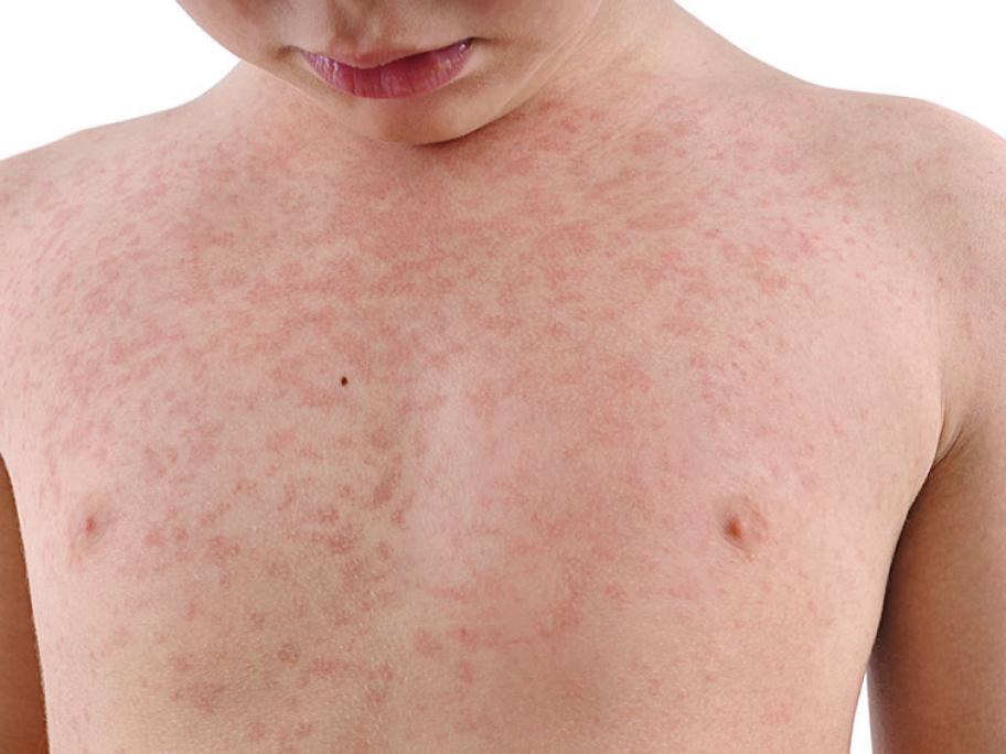 measles