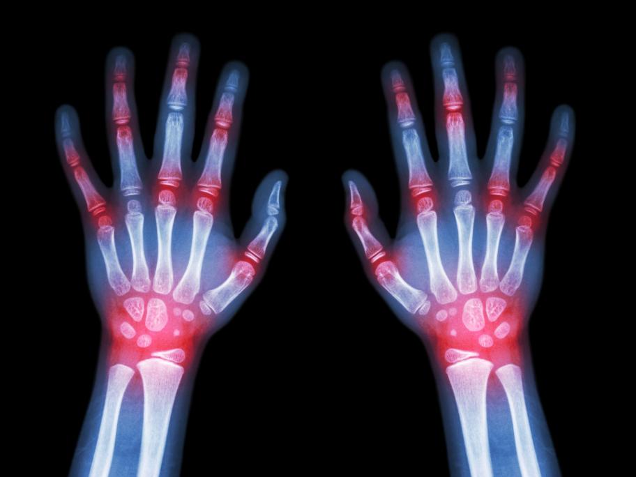 rheumatoid arthritis