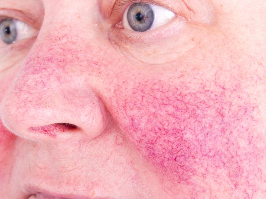 Rosacea